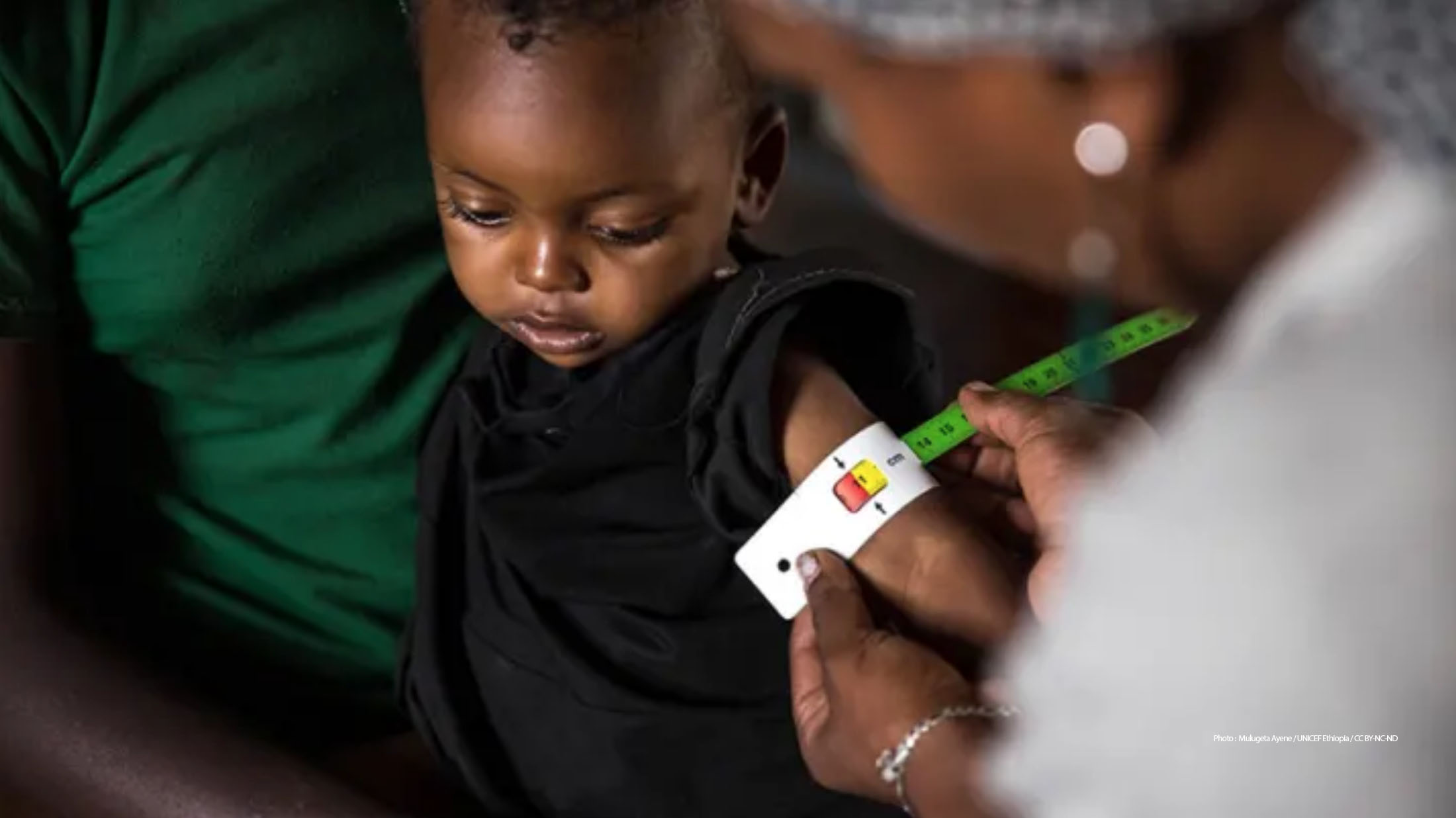 A health extension worker examines a child diagnosed with severe acute malnutrition. Photo by Mulugeta Ayene / UNICEF Ethiopia / CC BY-NC-ND